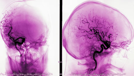 Cerebral Angiography