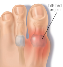 gout