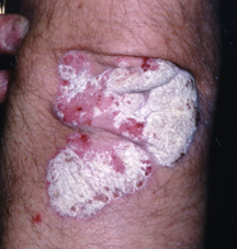 psoriasis