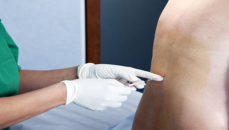 Epidural Block