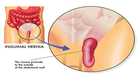Hernia Repair