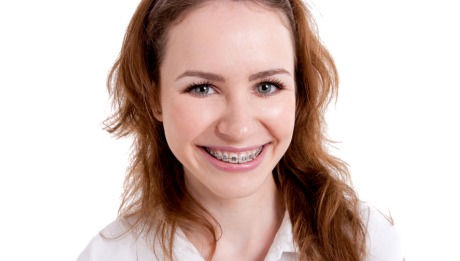 Dental Braces