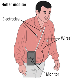 Atrial fibrillation 3