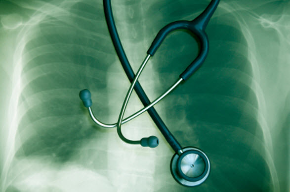 How Cancer Spreads to the Bones