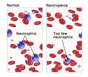 Neutropenia Neutropenia