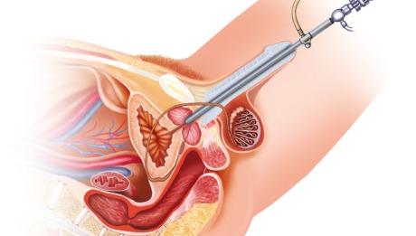 Cystoscopy - 460x261