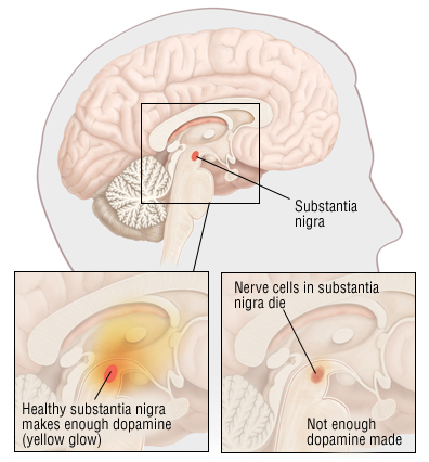 Parkinsons