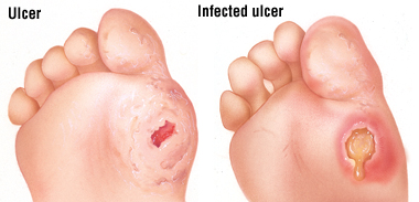 foot ulcer foot ulcer