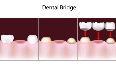 Dental Bridges