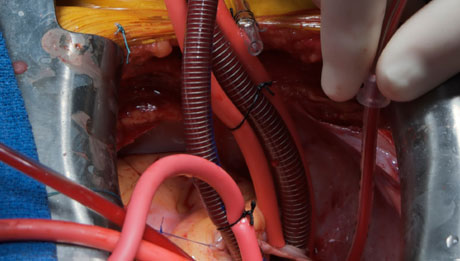 Open Heart Surgery