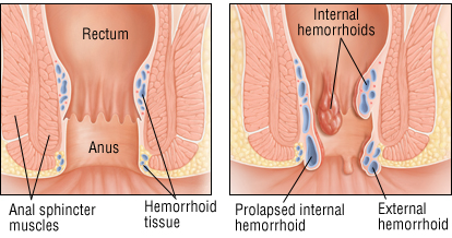 hemorrhoids hemorrhoids