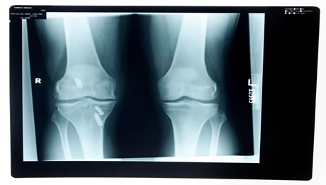 Anterior Cruciate Ligament Surgery
