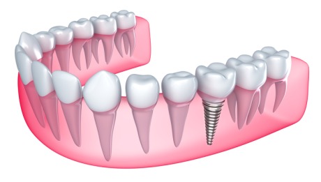 Dental Implants