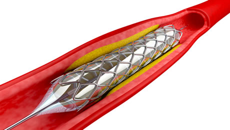 Coronary Angioplasty