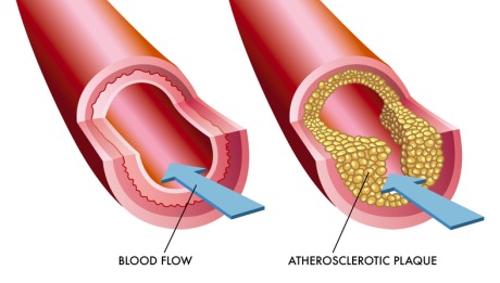 Coronary Atherectomy