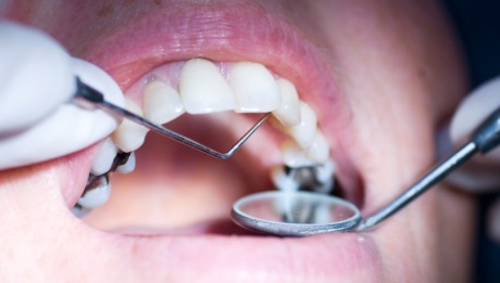 Dental Fillings