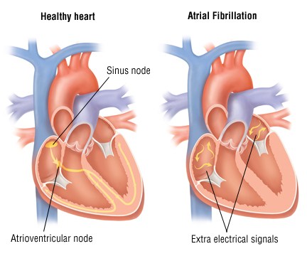 Atrial fibrillation 1