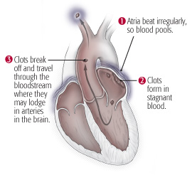 Atrial fibrillation 2