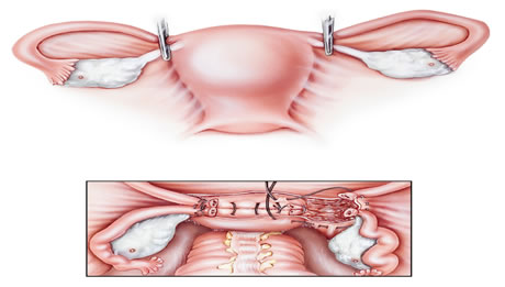 Hysterectomy