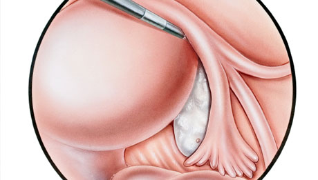 Pelvic Laparoscopy