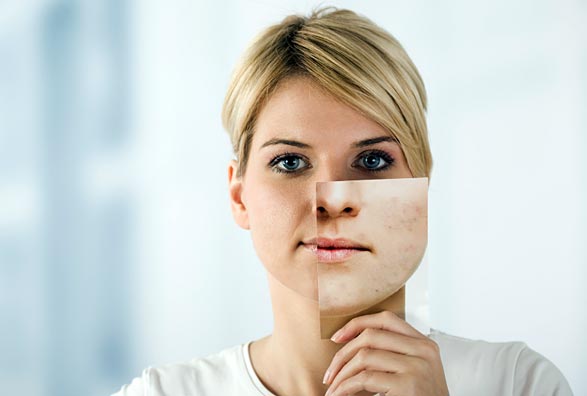 Woman holding up an image of rosacea