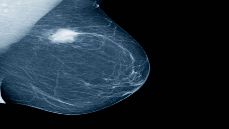 Lumpectomy