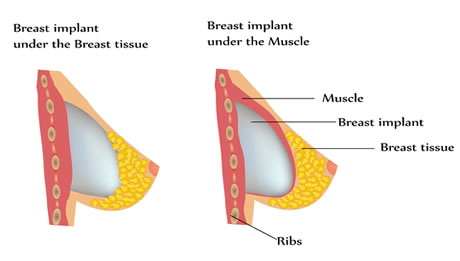 Breast Augmentation Surgery