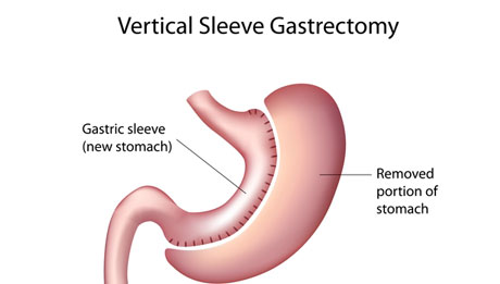 Gastrectomy