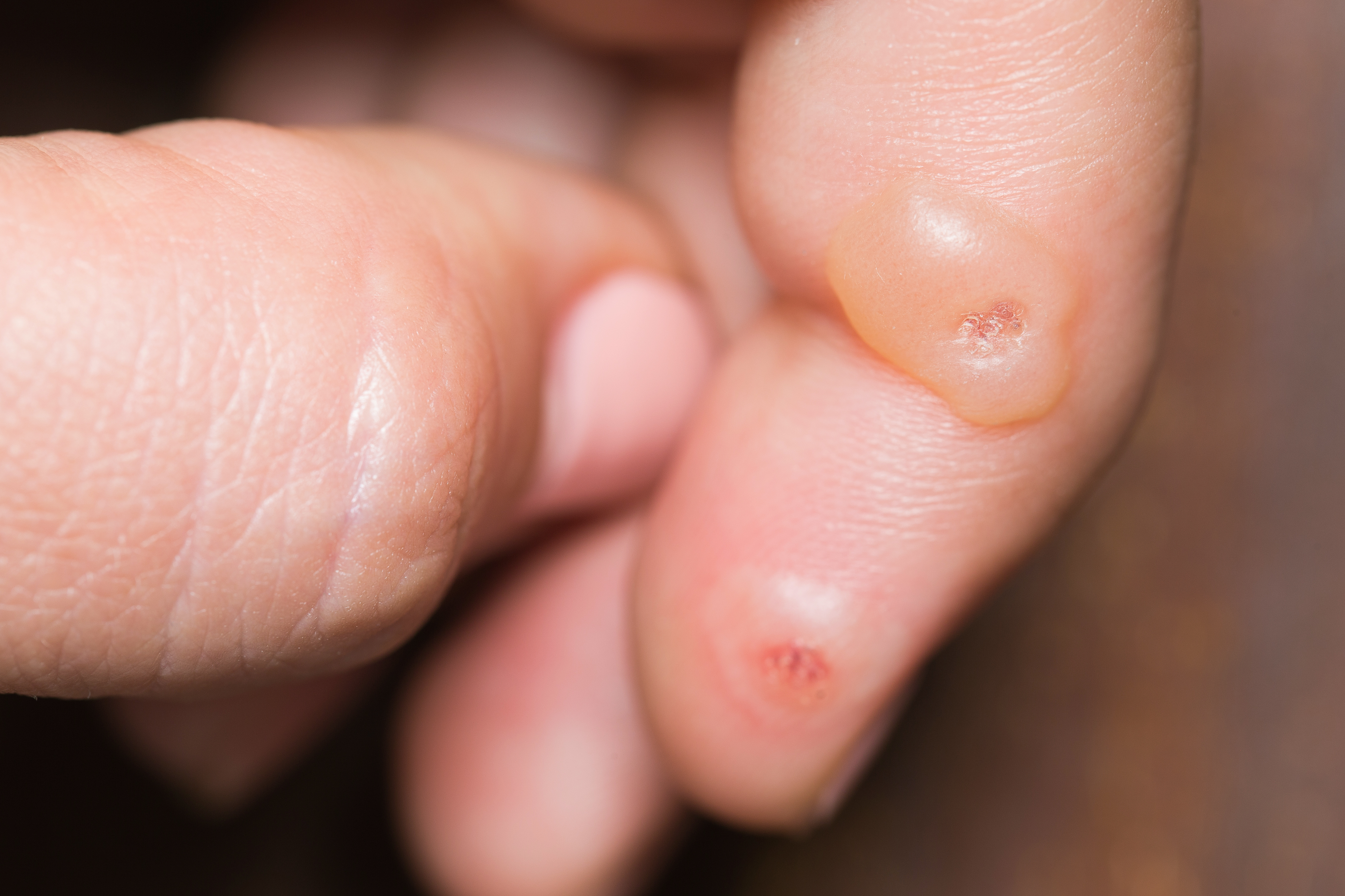 Wart virus on fingers, Hpv warts fingers