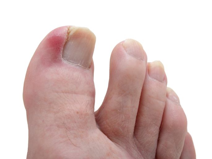 7 Common Causes Of Big Toe Pain
