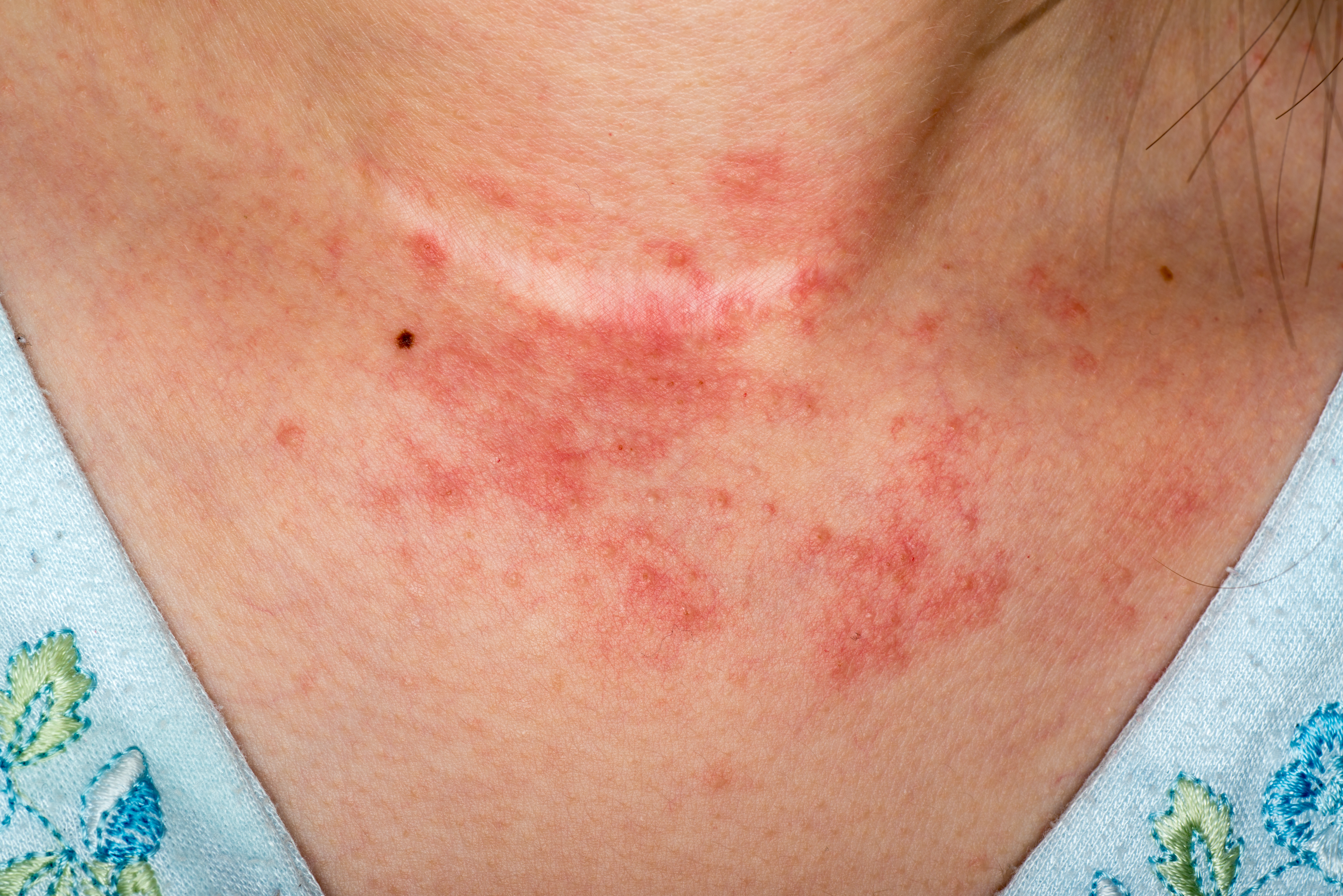 What Eczema Looks Like Eczema On Baby On The Face On The Hands What Eczema Looks Like Eczema On Baby On The Face On The Hands